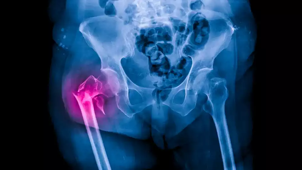 osteopeni nedir