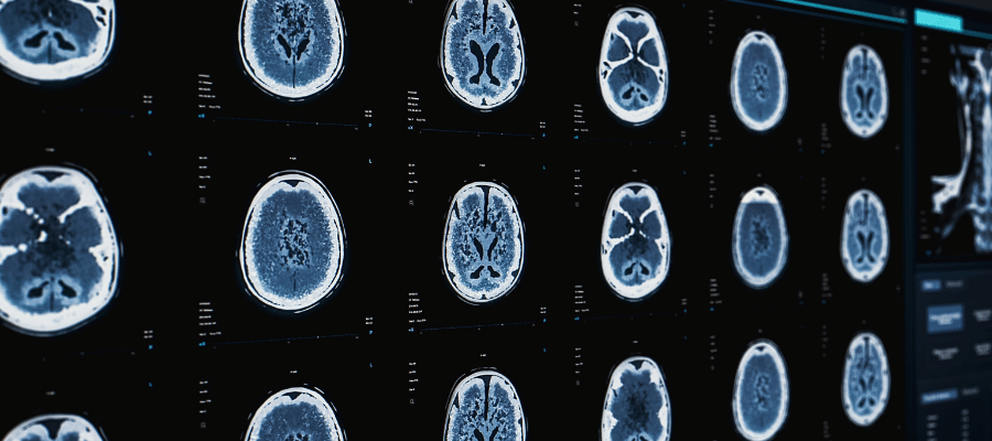 Beyin Sağlığını Korumak için Stresten Korunma Yöntemleri Nelerdir?