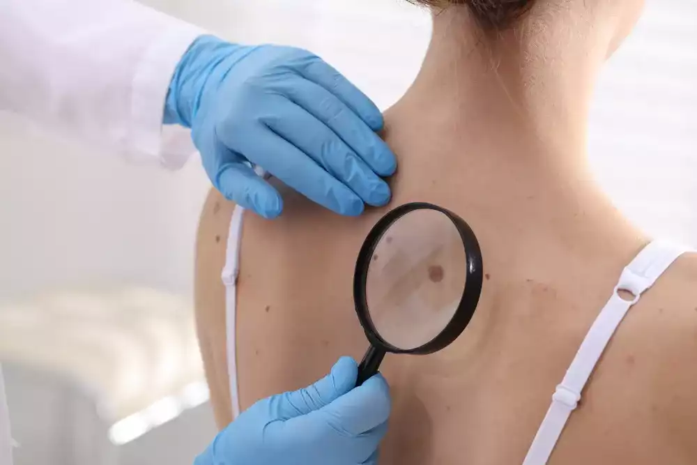 melanom genetik check up
