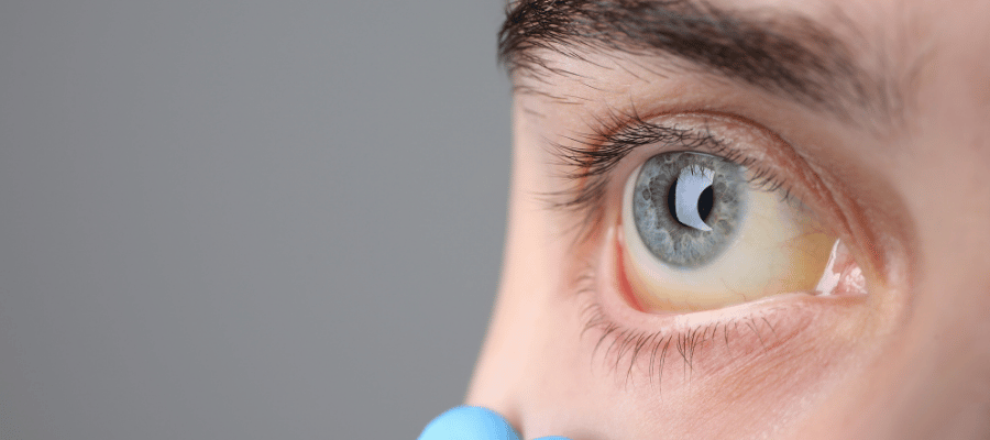 Bilirubin Yüksekliği Belirtileri Nelerdir?