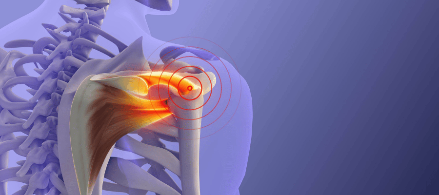 Donuk Omuz (Adheziv Kapsülit) Nedir?