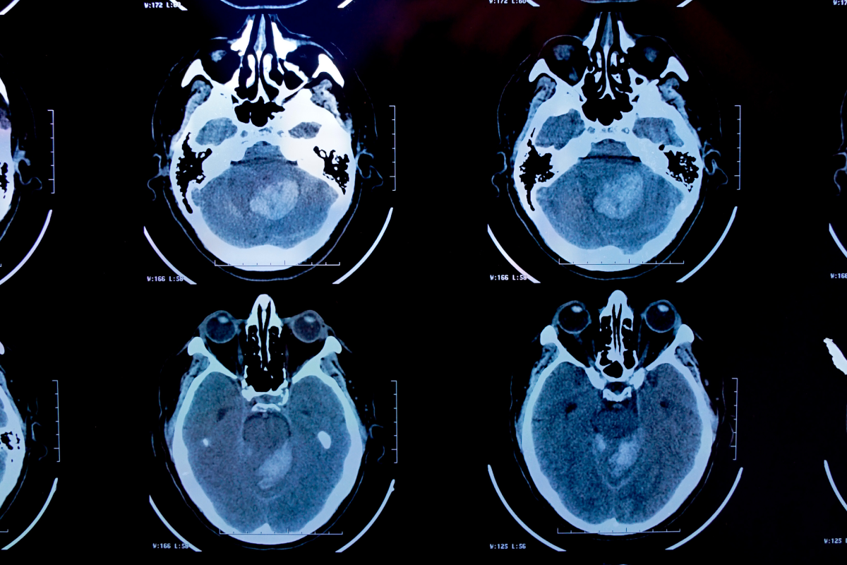 Epilepsi Nedir?