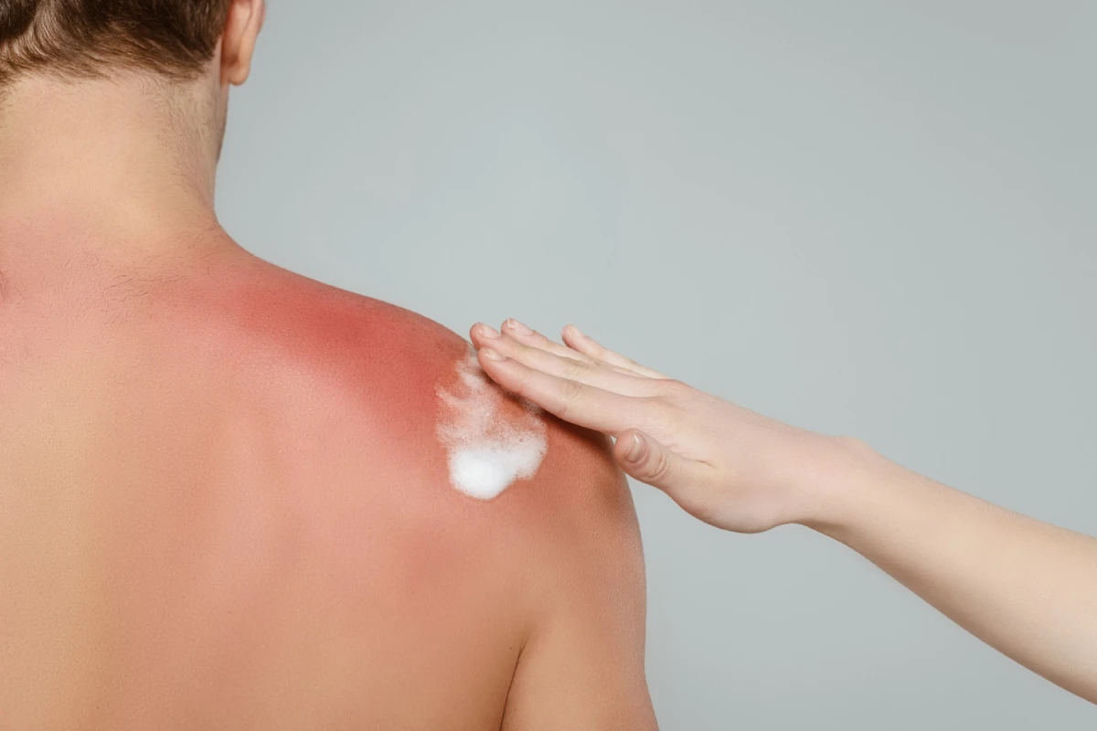 Güneş Alerjisi Nedir? Belirtileri ve Korunma Yolları