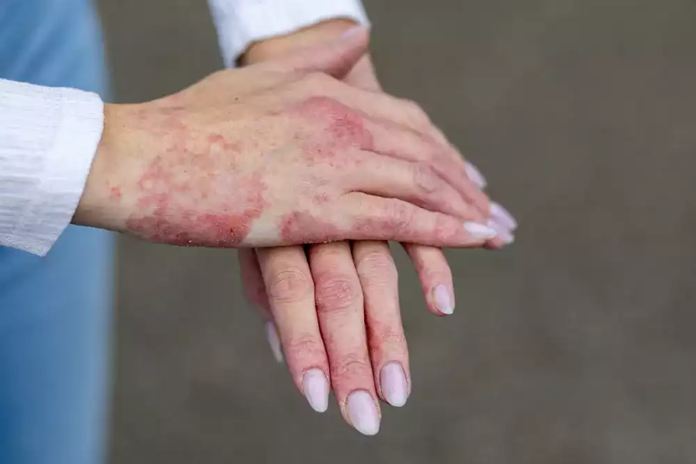psoriasis nedir